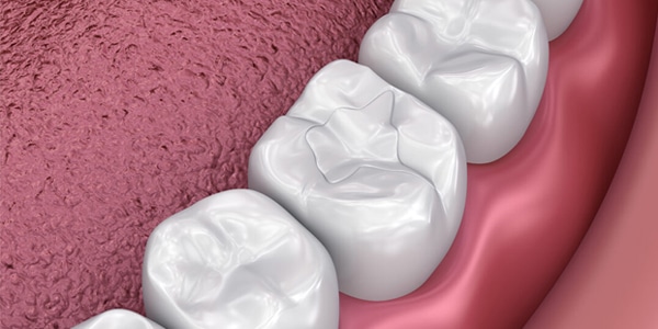 dental-sealants-san-antonio