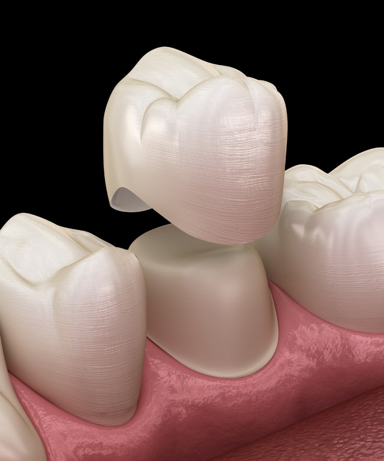 pediatric dental crowns in san-antonio