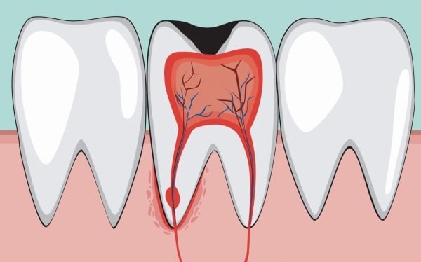 pulpotomy in san antonio
