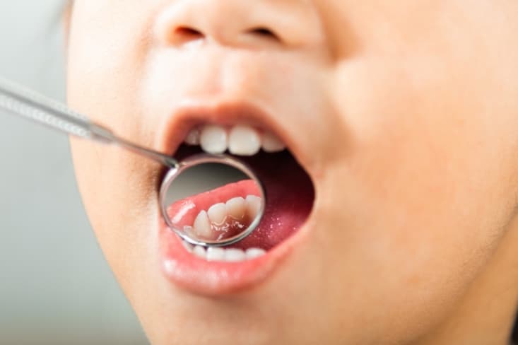 how to secure cavity prevention for kids